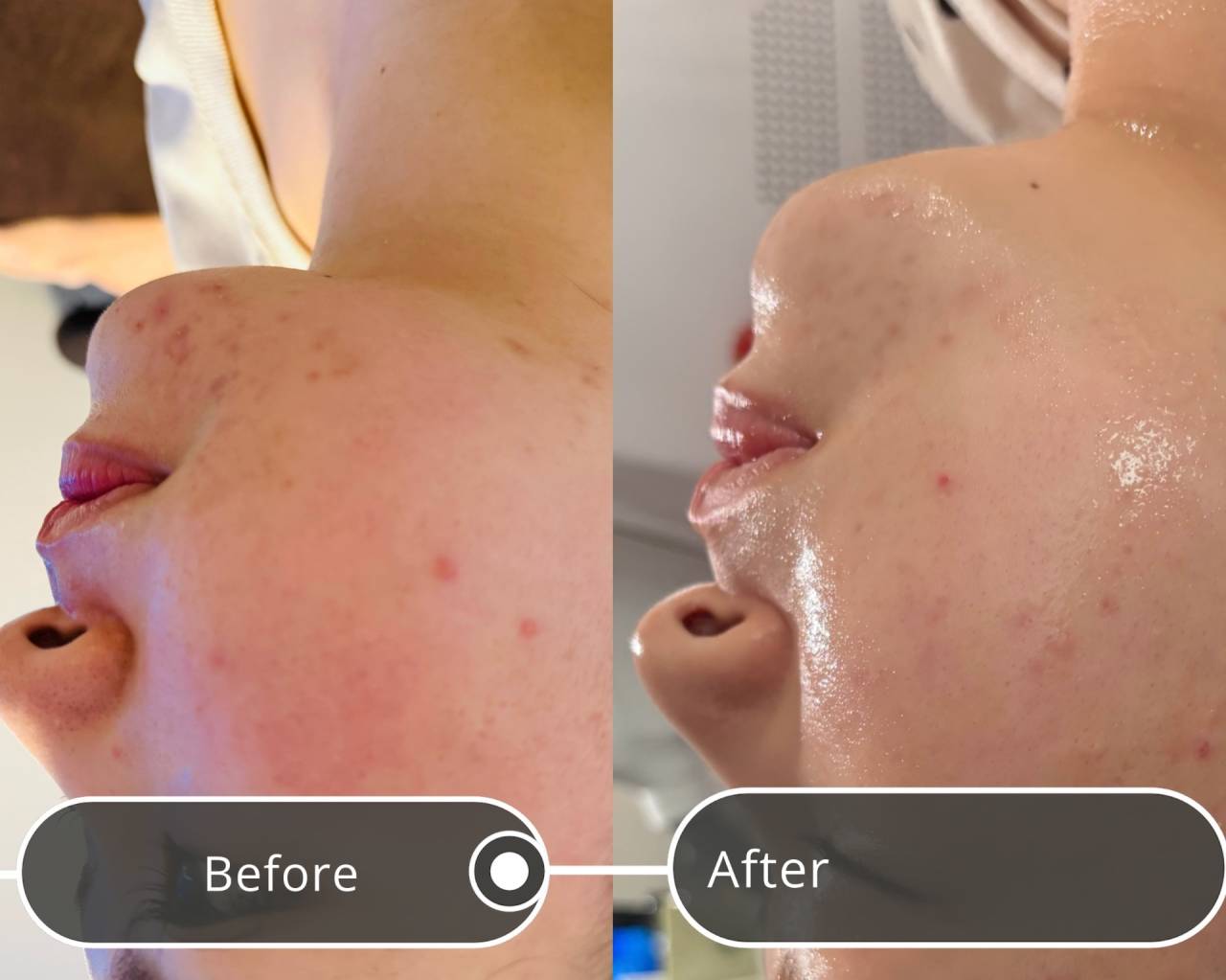 ニキビ改善得意です